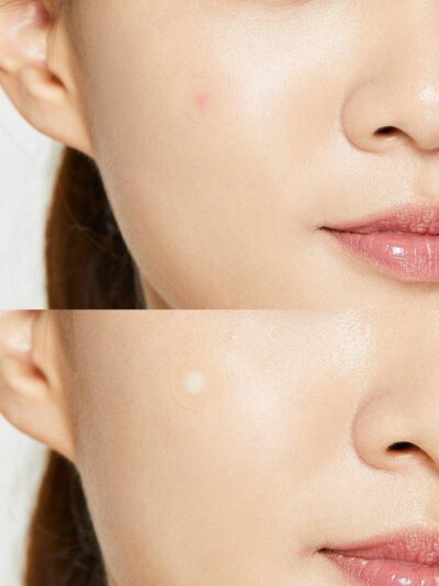 Cosrx - Acne Pimple Master Patch - 24 Patches - Image 4